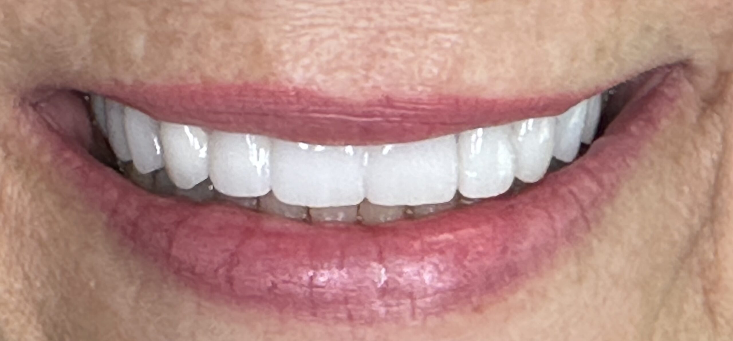 Exploring Full Mouth Teeth Replacement Solutions