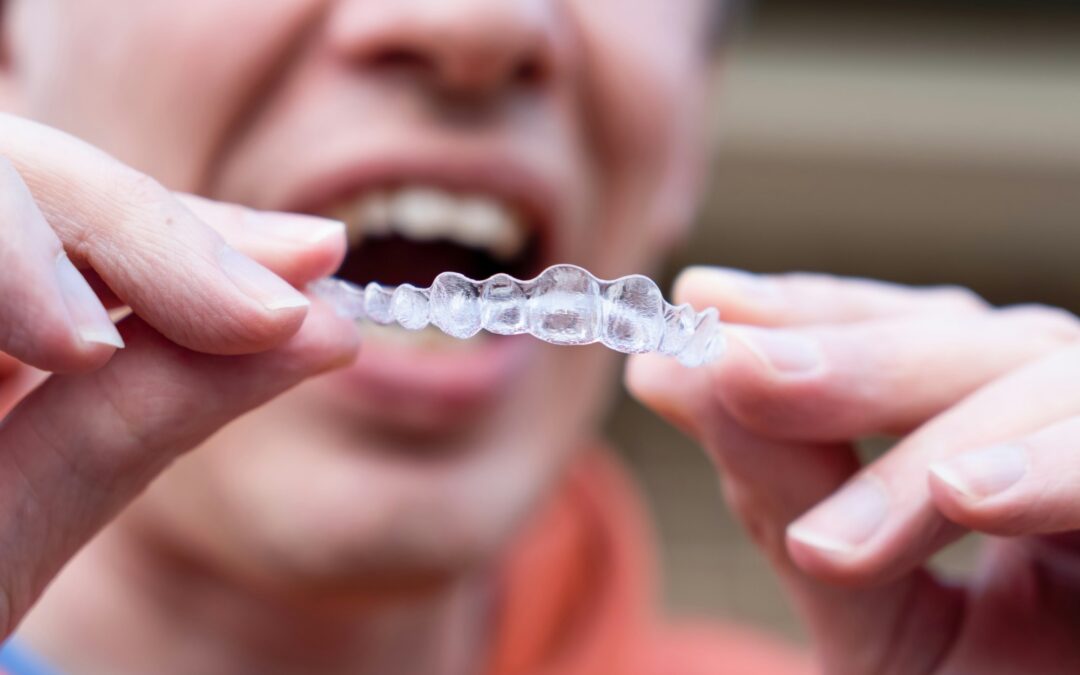 The Benefits of Choosing Invisalign Braces