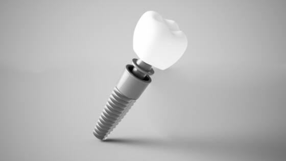 Cost of full mouth dental implants