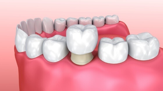 What does a dental crown look like?