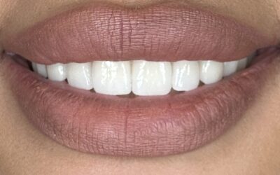 crowns after