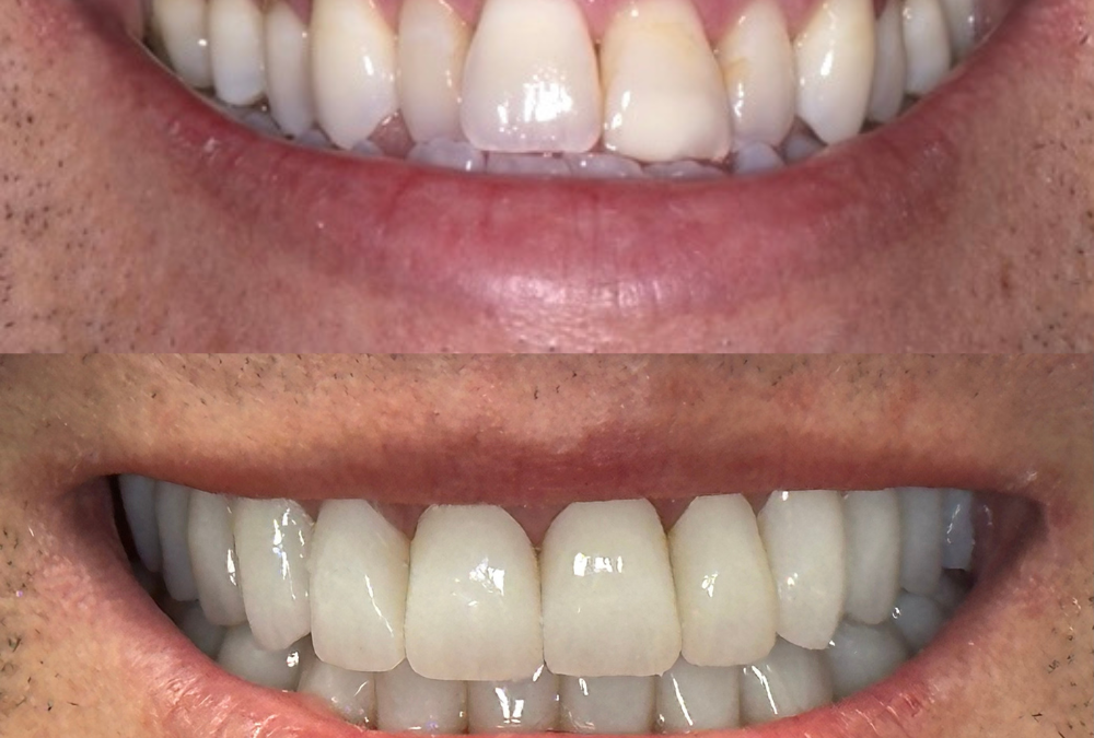 Smile Design: Crafting the Perfect Smile Just for You