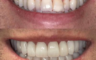 Smile Designing