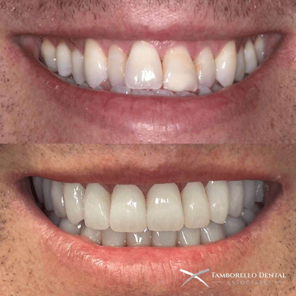 Smile Designing