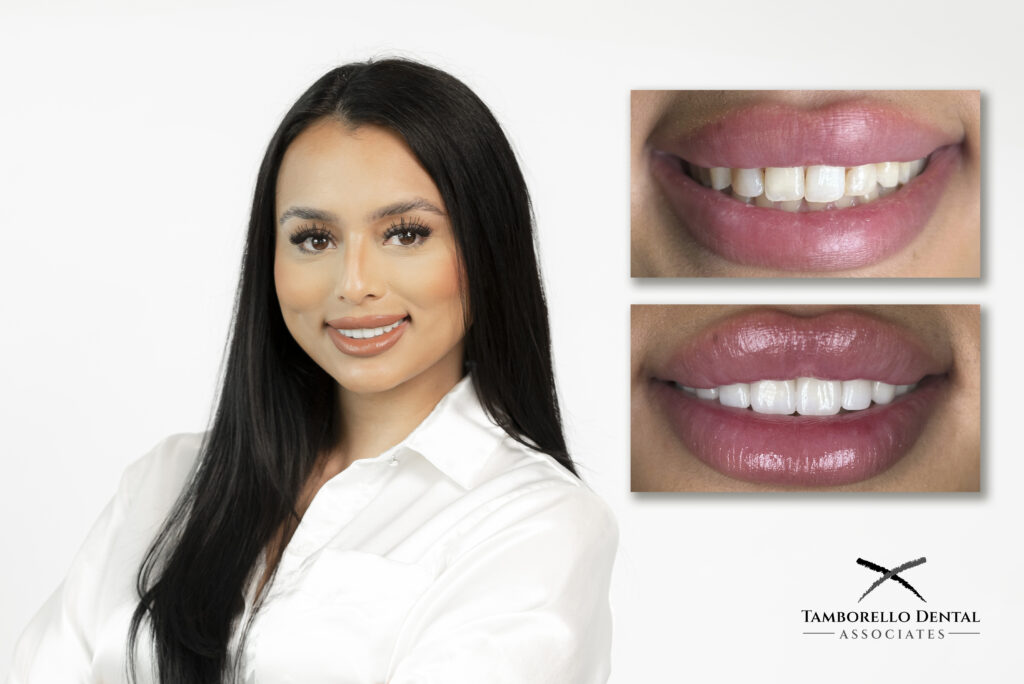 dental crowns before and after