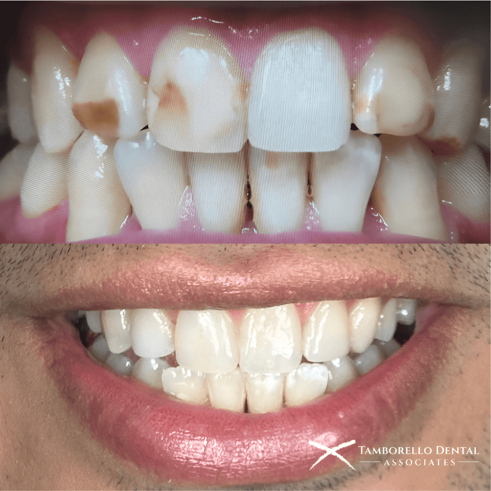 Dental Bonding Houston