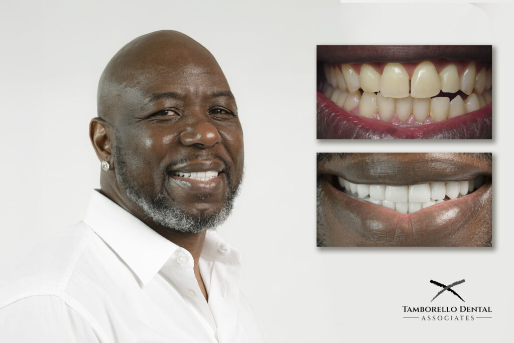 reconstruction, smile design, Houston, cosmetic dentist