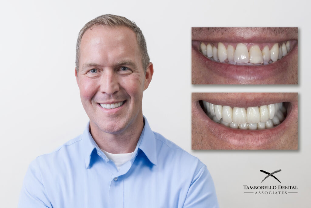 reconstruction, smile design, Houston, cosmetic dentist