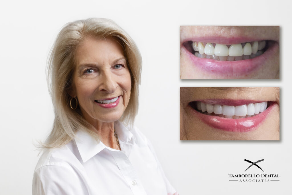 Full mouth arch reconstruction, smile design, Houston, cosmetic dentist