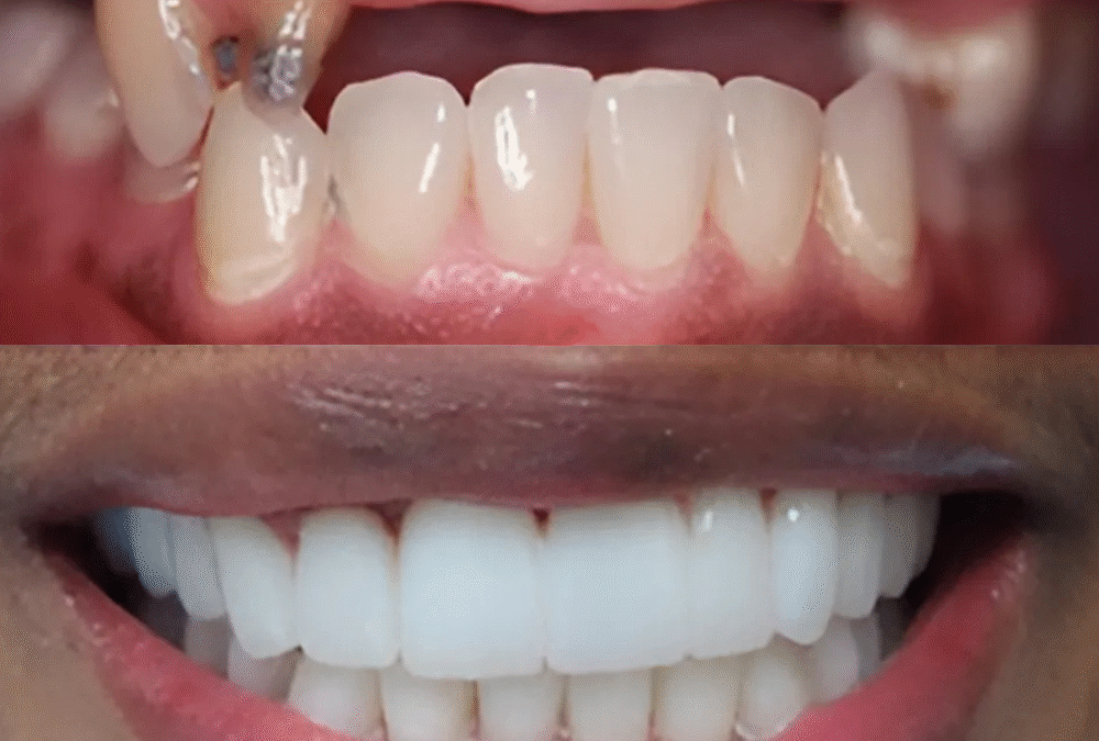 How Long Do Dental Implants Take to Heal? | Tamborello Dental Associates – Houston, TX