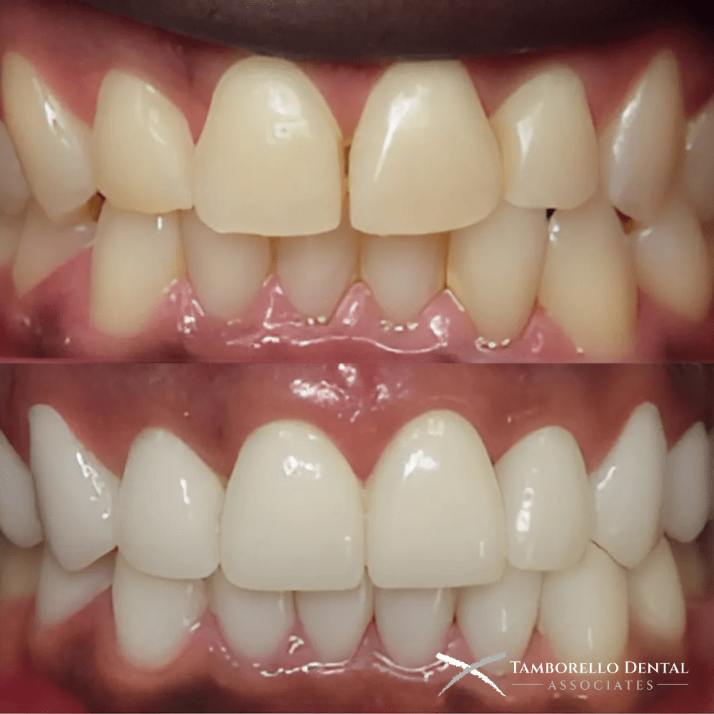 Smile Makeover Dental Crowns