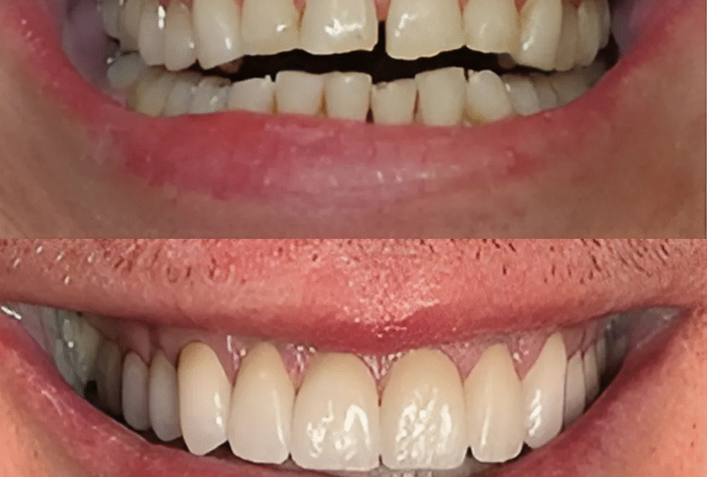 What Is an Arch in Dental Implants? | Tamborello Dental Associates Houston, TX