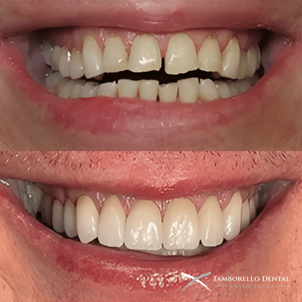Smile Makeover Full Arch