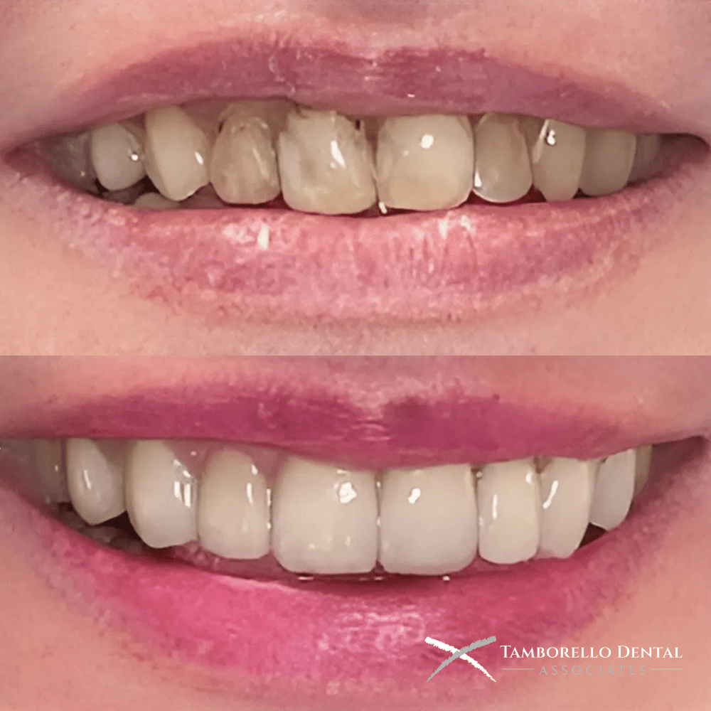 Smile Makeover Staining