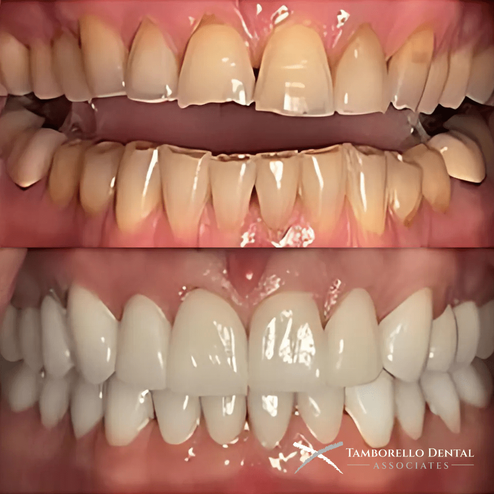 Smile Makeovers