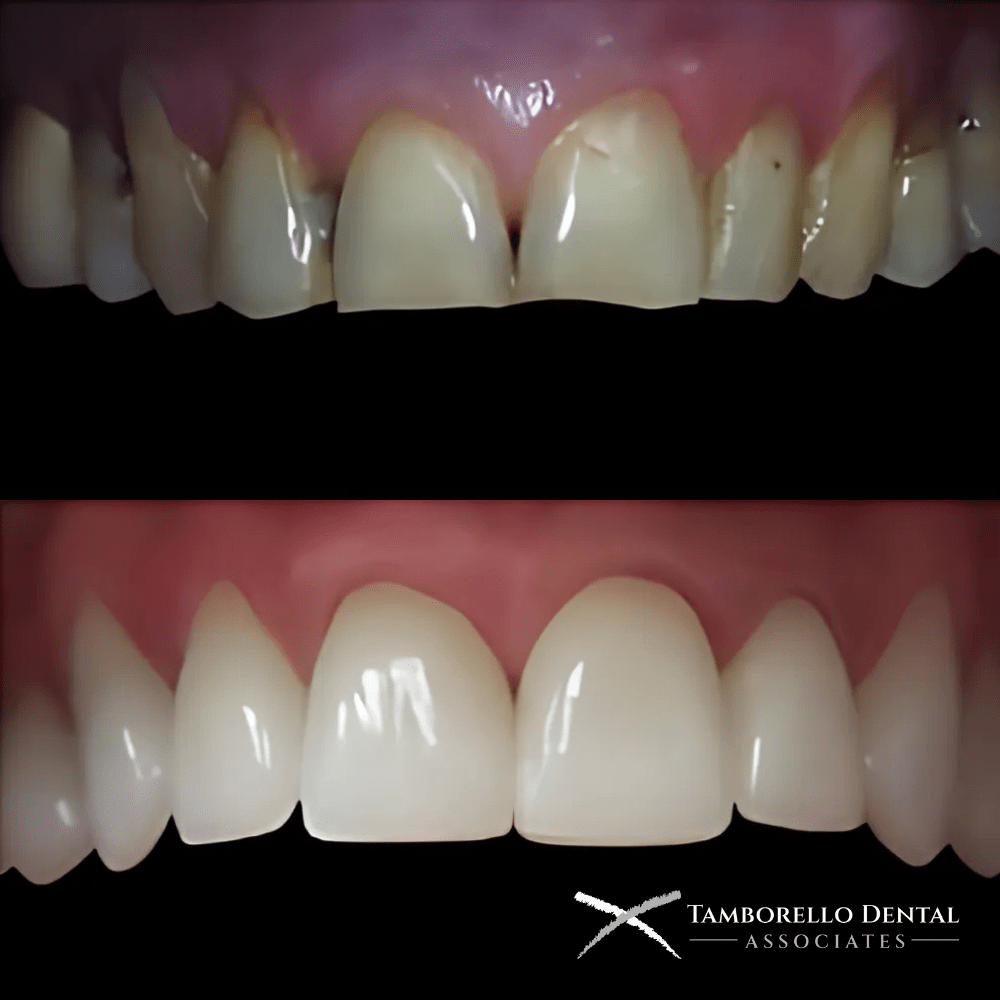 Smile Makeovers Upper Arch